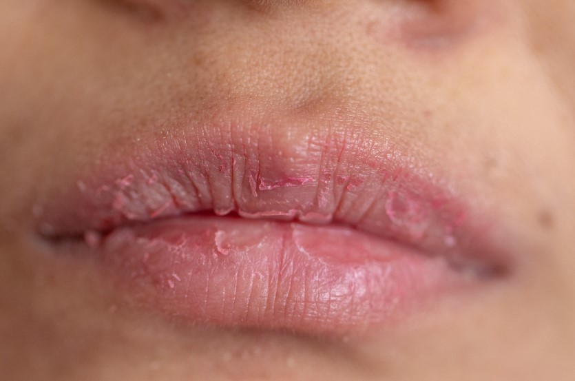 יובש מסביב לשפתיים